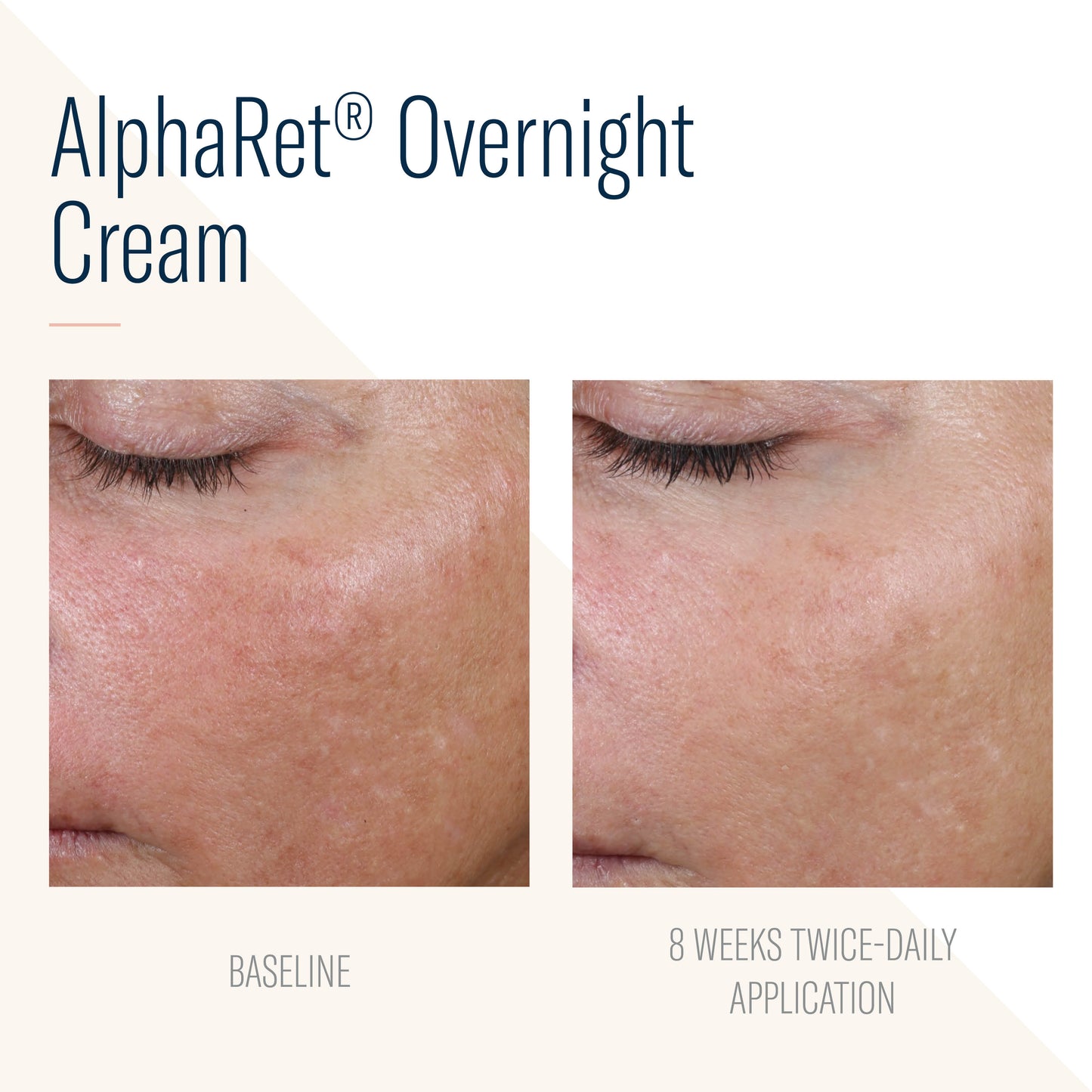 SBS AlphaRet Overnight Cream